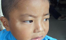 儿童白色糠疹是什么原因导致的 儿童白色糠疹白斑多久能消